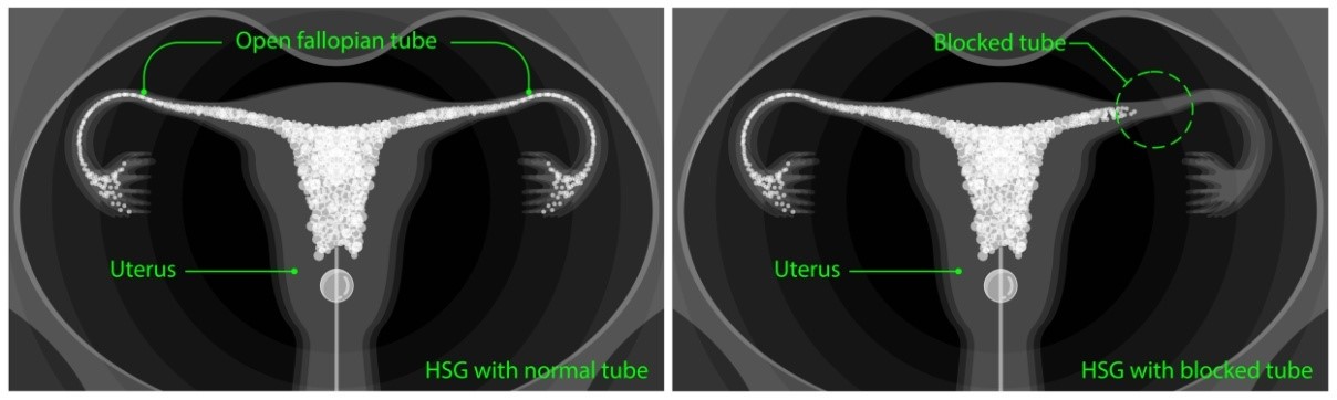 Fallopian Tube Testing